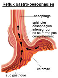 Reflux gastro-oesophagien : causes & traitements | Creapharma