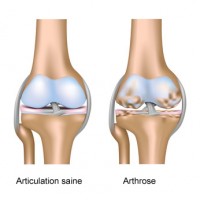Arthrose infographie