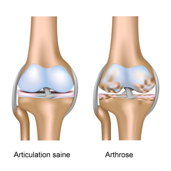 6 exercices contre l'arthrose du genou 