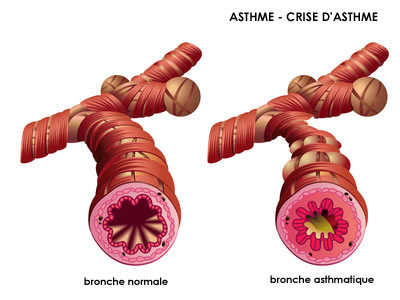 Définition de l'asthme