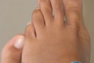 Arbre à thé - contre le mycoses des pieds