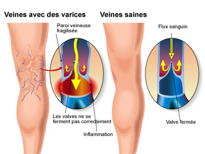 Varices : causes, symptômes & traitements | Creapharma