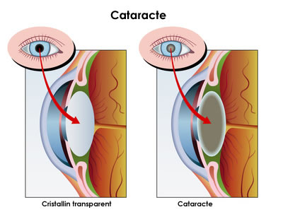 cataracte résumé shema