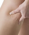 cellulite définition