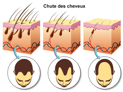 chute de cheveux bon conseil