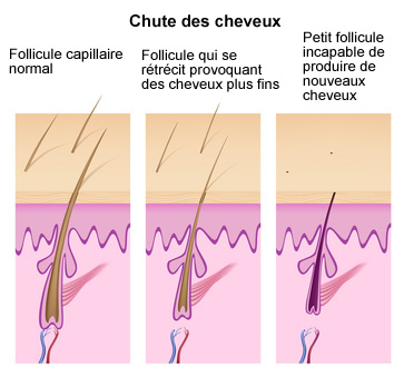 chute de cheveux symptôme infographie définition