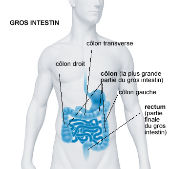 cancer colorectal différence