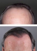 chute de cheveux symptôme