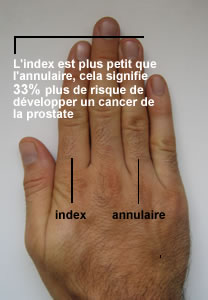 cancer de la prostate doigt symptôme