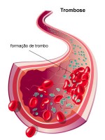 Thrombose résumé