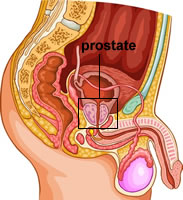 Définition hyperplasie bénigne de la prostate