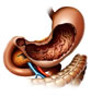 Reflux gastro-oesophagien