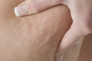 Remède cellulite - Gommage