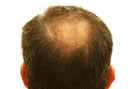 Biotine - chute des cheveux