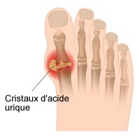 indications colchicine