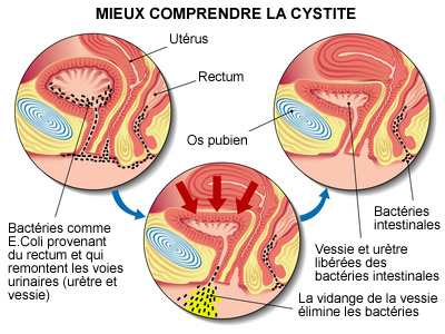 Cystite en résumé