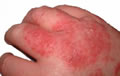 Bicarbonate de soude eczéma - en bain