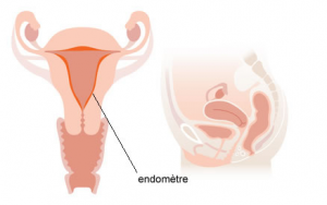 définition endométriose