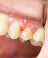gingivite définition