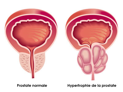 hypertrophie de la prostate : symptômes