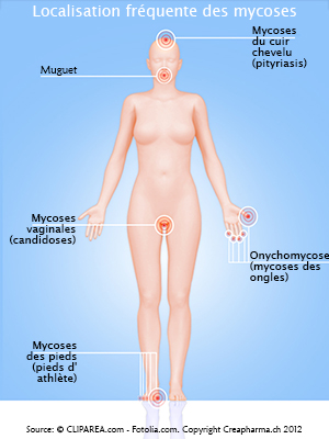 Mycoses infographie