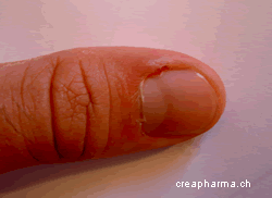 Panaris Causes Symptomes Traitements Creapharma Panaris Causes Symptomes Traitements Creapharma