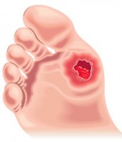 colchicine indication