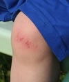 Pommade au souci contre les plaies et blessures