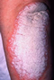 Symptômes psoriasis