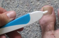 Traitements mycoses des ongles