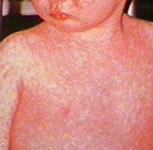 Épidémie de rougeole 