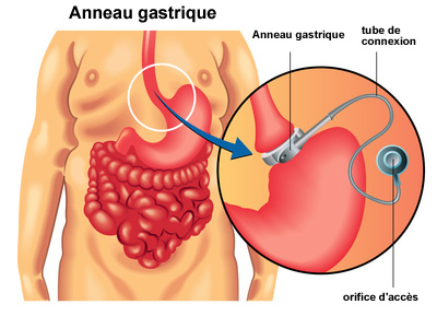 Chirurgie de l'obésité