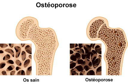 Ostéoporose, Définition, symptômes, traitement
