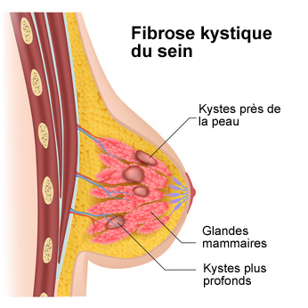 Fibrose kystique du sein : symptômes et traitements | Creapharma