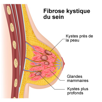 Les différents types de kystes mammaires - Symptômes, Diagnostic &  Traitements