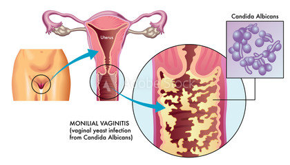 Mycoses vaginales : causes, symptômes & traitements | Creapharma