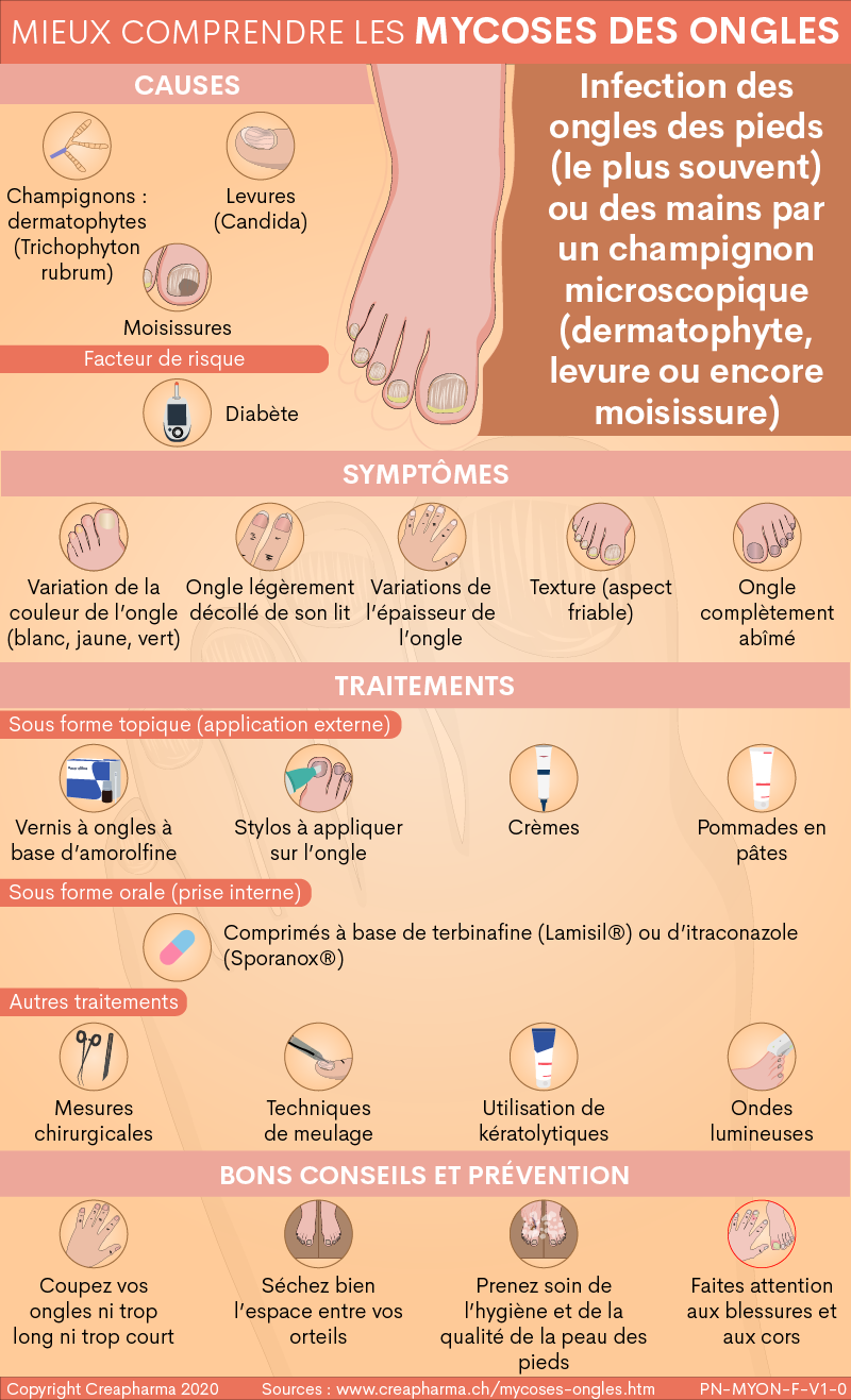 Mycoses des ongles de pied (onychomycose) : 5 erreurs à ne pas faire :  Femme Actuelle Le MAG