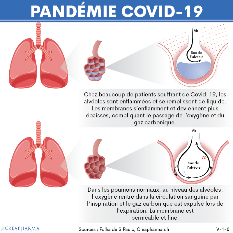 Pneumonie Causes Symptômes And Traitements Creapharma