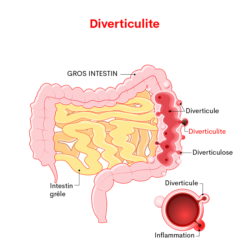 Diverticulite : causes, symptômes & traitements | Creapharma