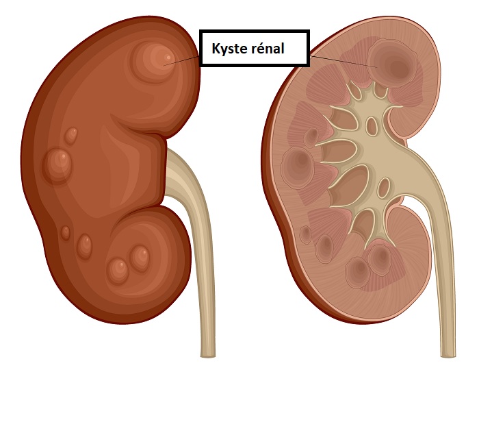 Kyste rénal - Polykystose rénale | Creapharma