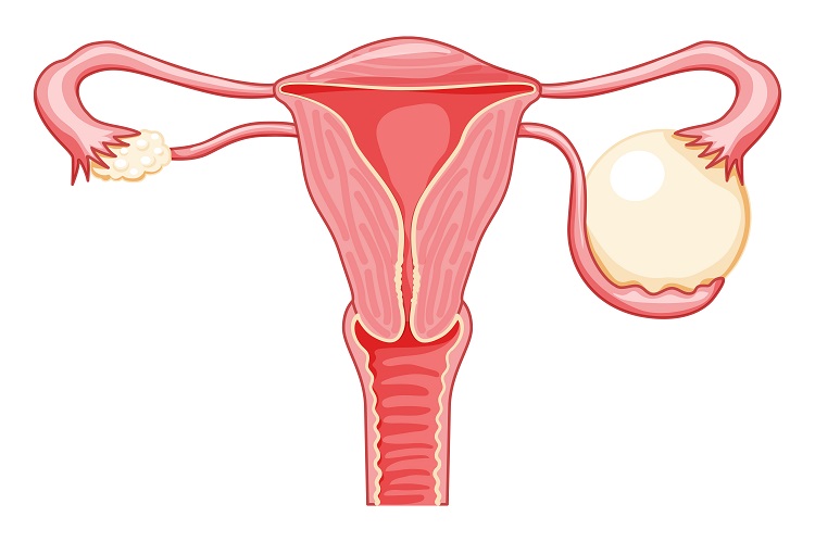 Kyste de l'ovaire : symptômes - traitements | Creapharma