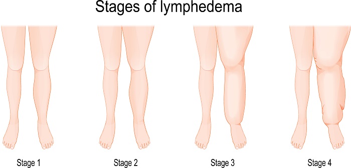 Lymphoedème : causes, symptômes & traitements | Creapharma